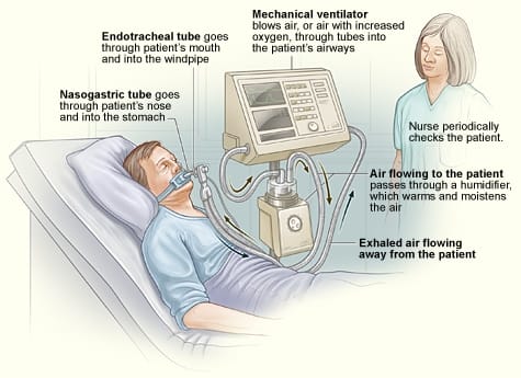 Why do you need a Ventilator for COVID-19?