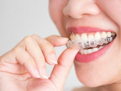 Top 10 Best Invisalign Clinics in Kuala Lumpur Malaysia