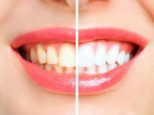 Teeth Whitening in Auckland