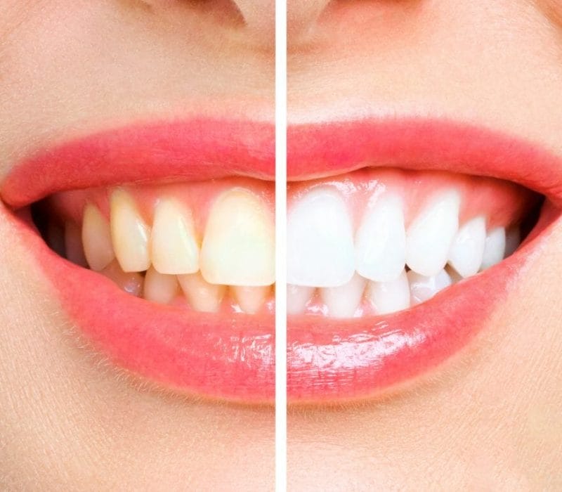 Teeth Whitening in Auckland
