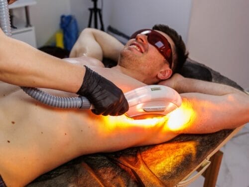 The Best Guide for Men Laser Hair Removal Treatment in Singapore