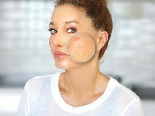 Unlock Flawless Skin with These Acne Scar Facials in Singapore