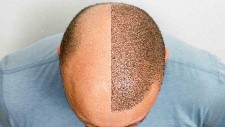 How To Stop And Reduce Hair Loss [Part 2]