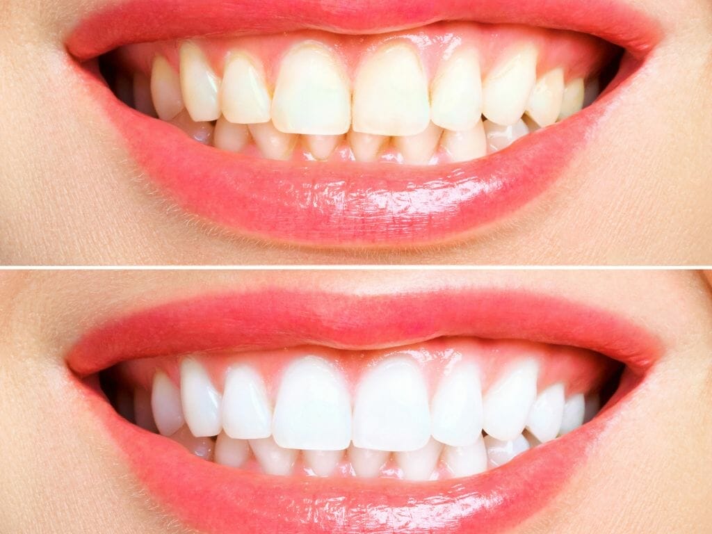 Teeth Whitening on a Budget The Top 10 Places to Go in Singapore