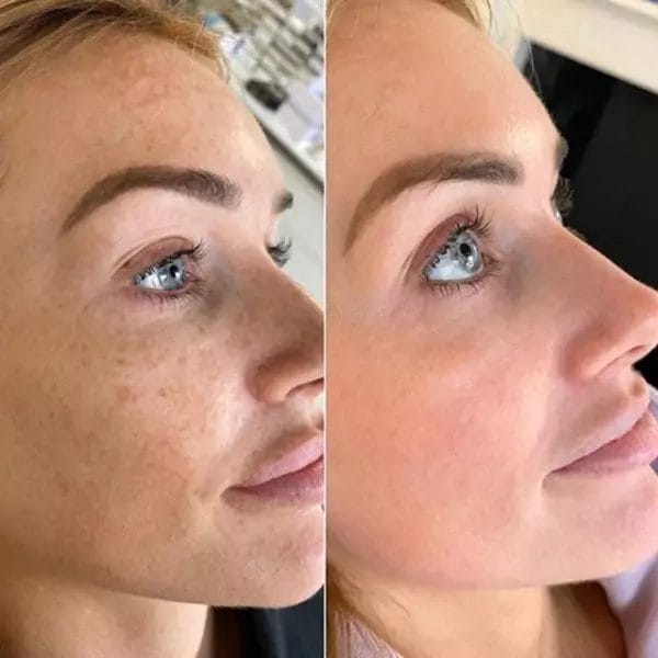 While hyperpigmentation can be notoriously difficult to deal with, the bright side is there's a variety of ways to do so
