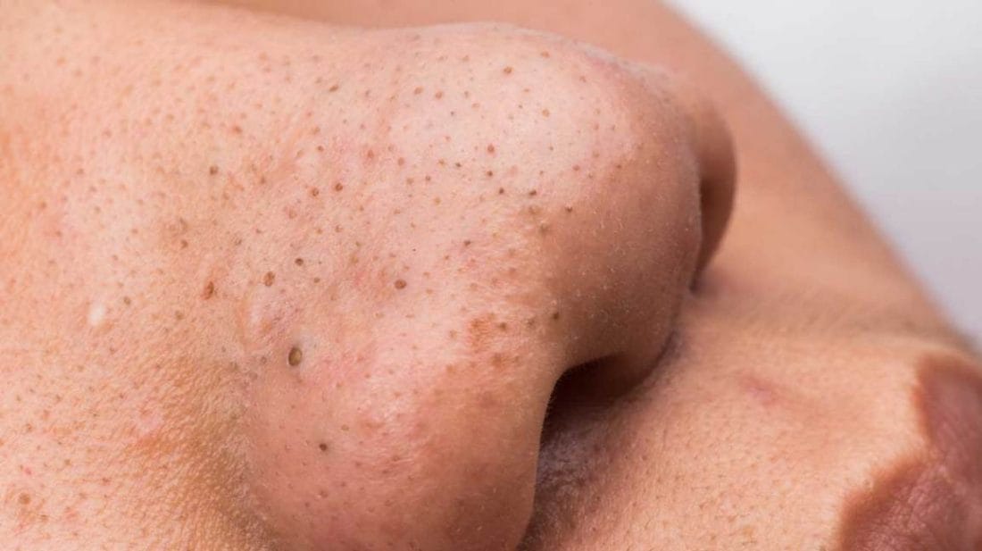The Best Ways to Eliminate Blackheads [Gent's Edition]