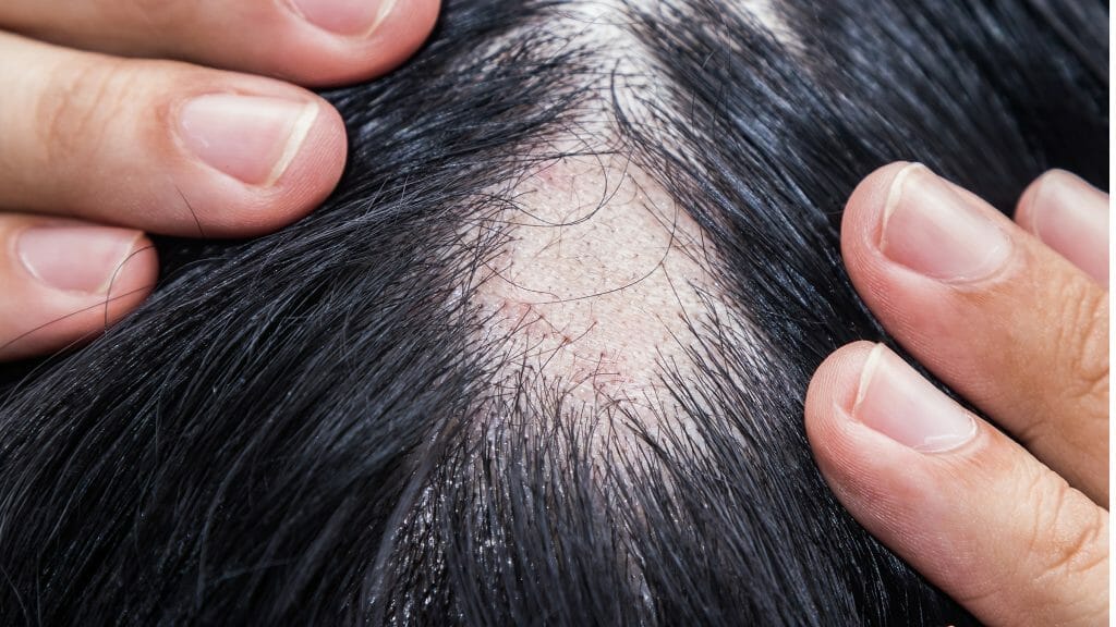 Except for loss due to genetic factors, hair loss is usually temporary. 