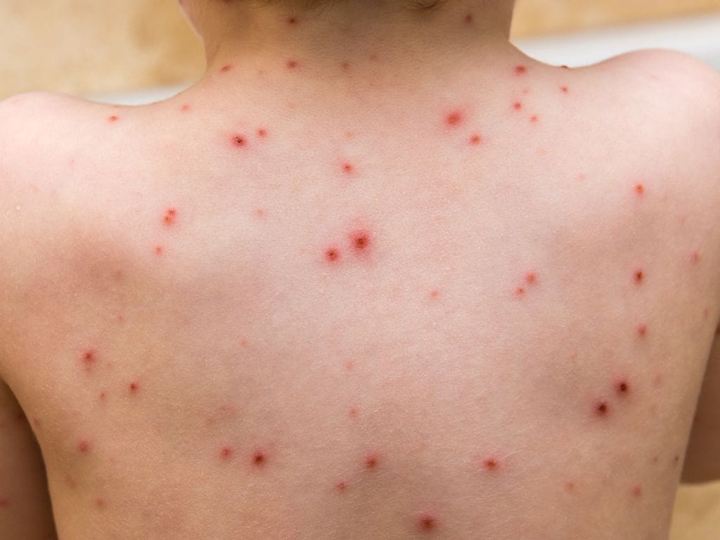 Tell-Tale Signs of Your Kid’s Chicken Pox