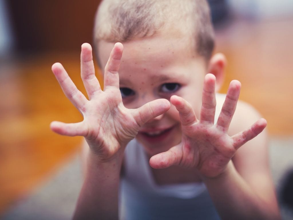 Tell-Tale Signs of Your Kid's Hand, Foot and Mouth Disease