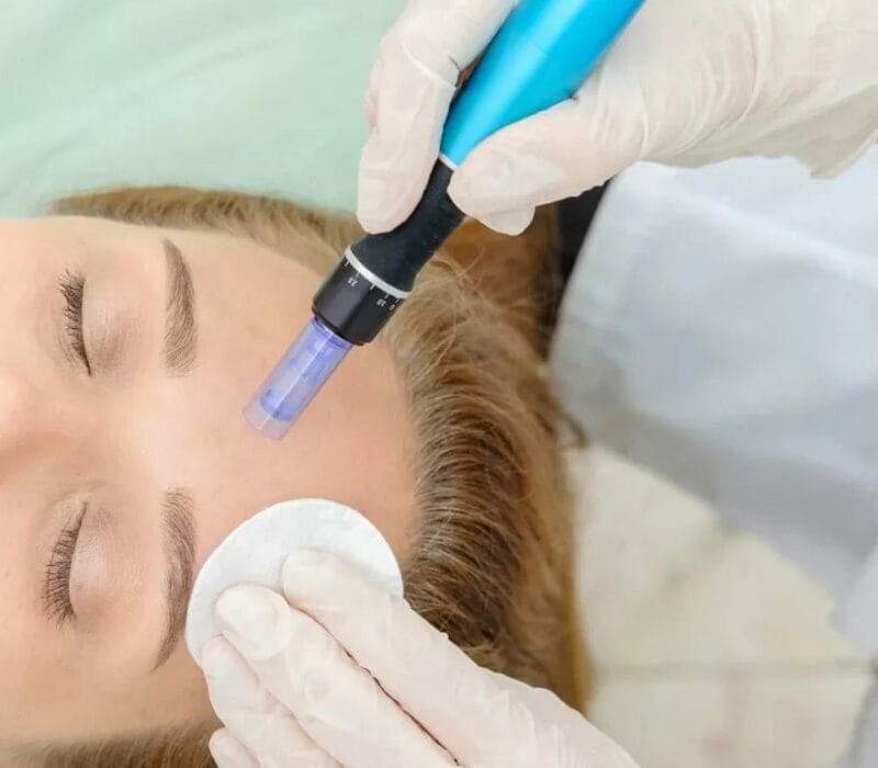 10 Things to Consider When Choosing a Microneedling Clinic in Singapore