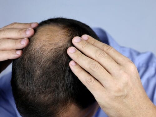 Asian Men's Hair Loss