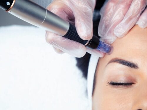 The Truth about Microneedling in Singapore Do You Know