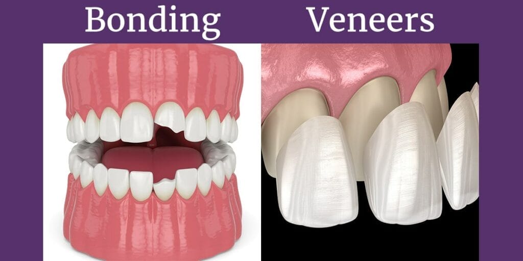 The Role of Dental Bonding in Veneer Discoloration