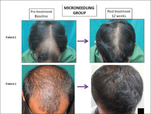 Microneedling Stimulates Hair Regrowth