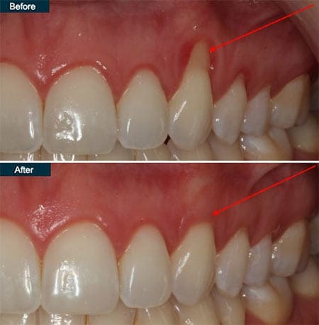 Impact of Gum Recession on Veneer Appearance