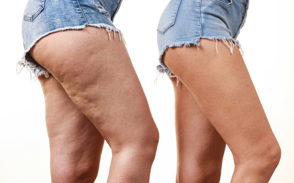 Cellulite and Fat Freezing