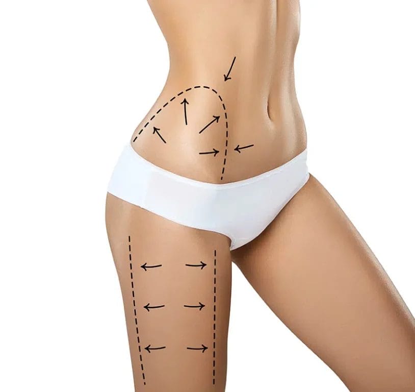 Comparing Fat Freezing to Traditional Liposuction