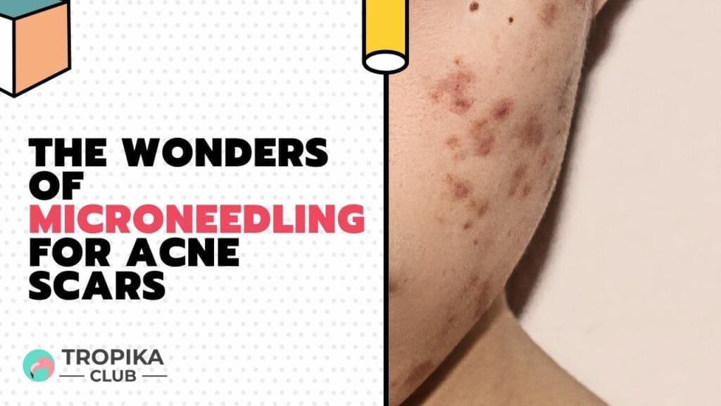 The wonders of Microneedling for Acne Scars