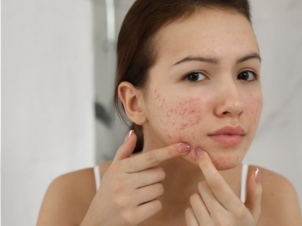 How to Beat Teenage Acne Tips for Singaporean Teens