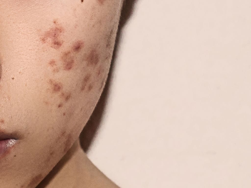 The wonders of Microneedling for Acne Scars