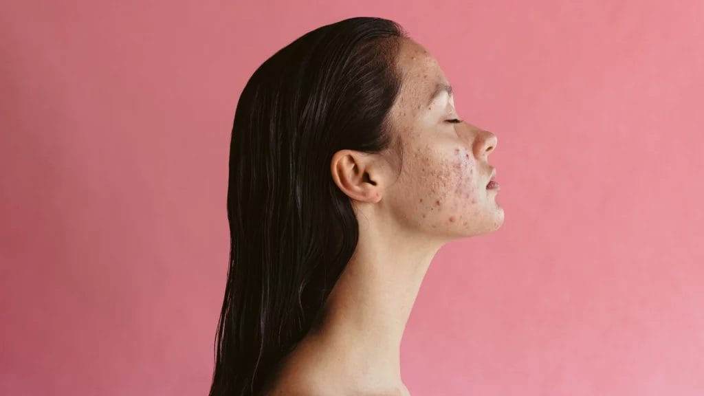 Hormonal Influences on Teen Acne