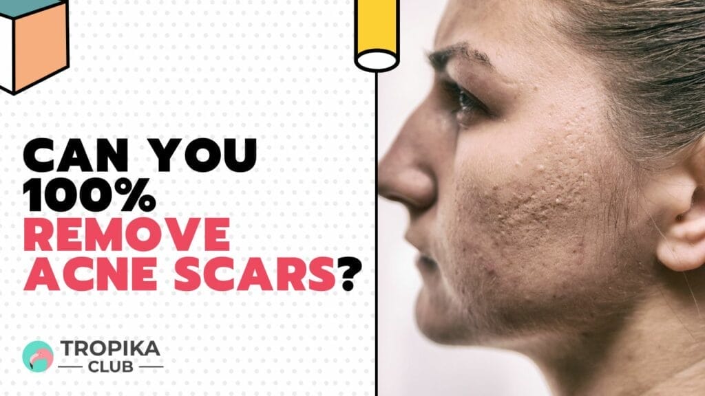 Can you 100% remove acne scars