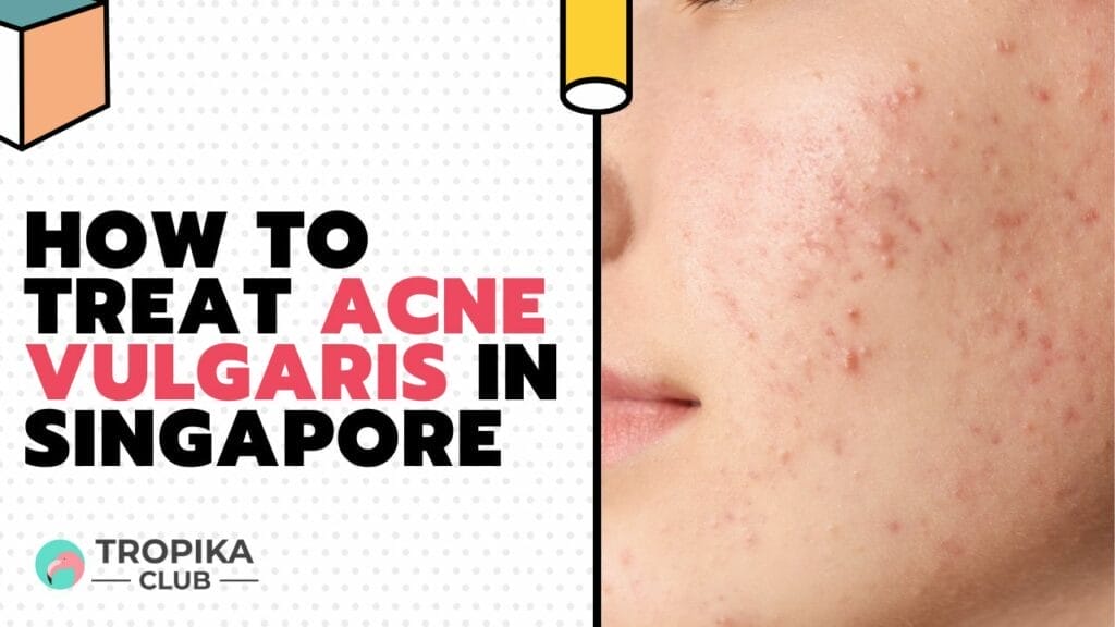 How to Treat Acne Vulgaris in Singapore