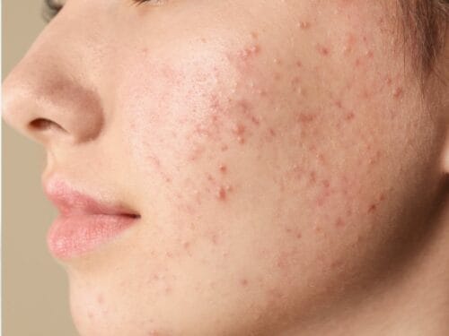 How to Treat Acne Vulgaris in Singapore