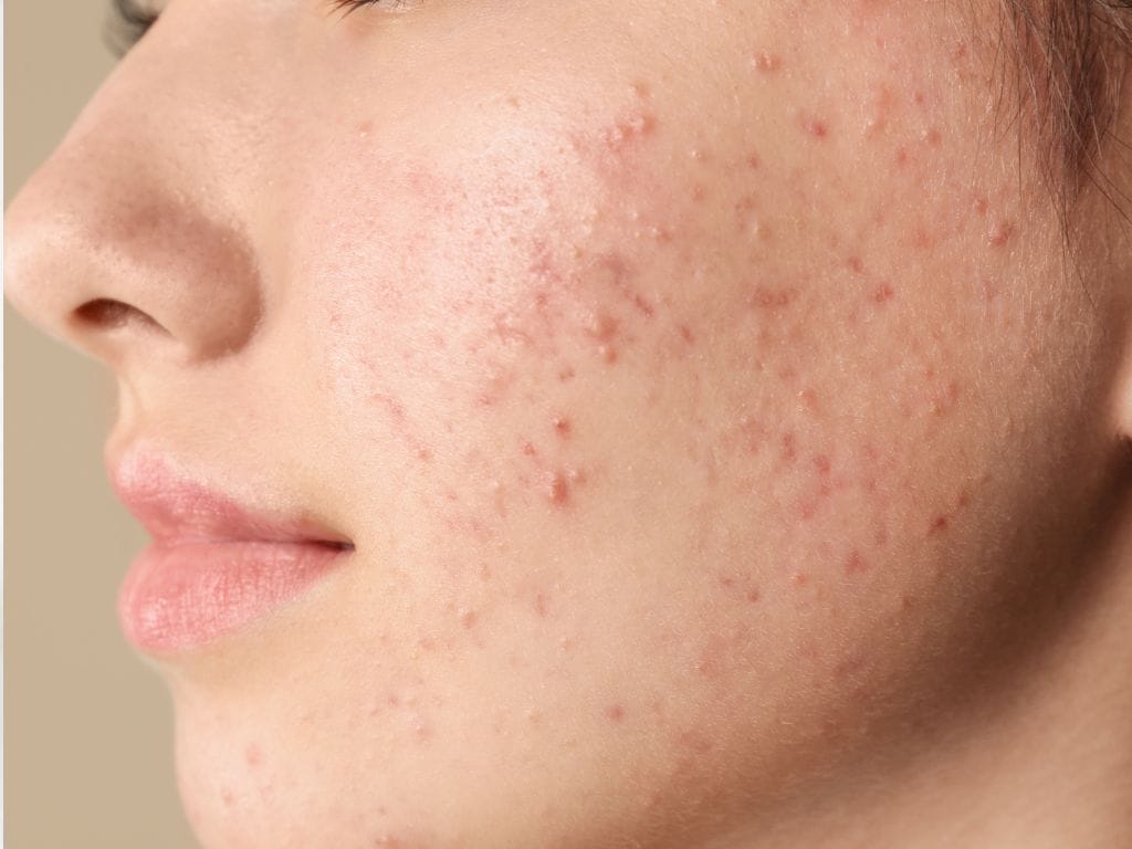 How to Treat Acne Vulgaris in Singapore