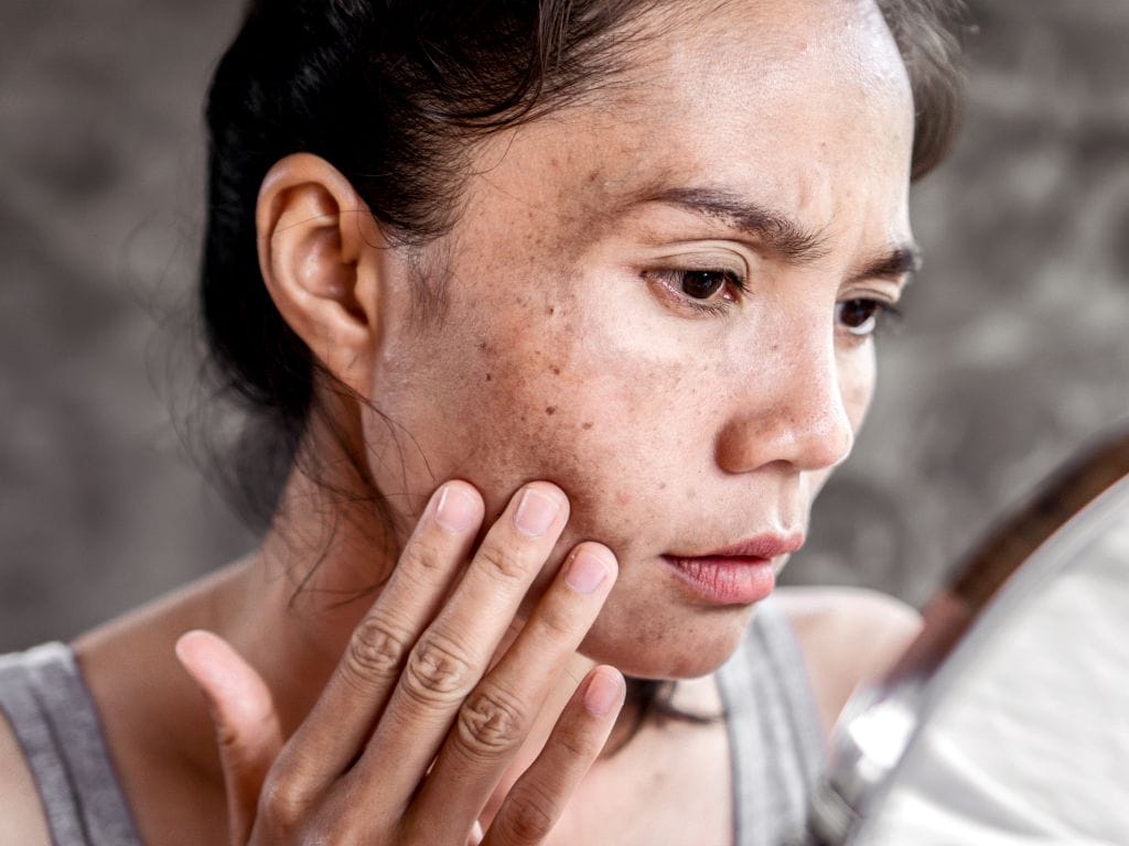 The Best Ingredients for Hyper-Pigmentation in Southeast Asian Skin