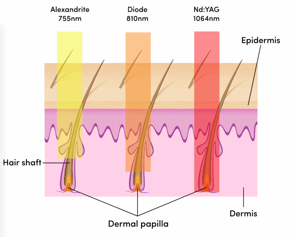 Laser Hair Removal Technologies