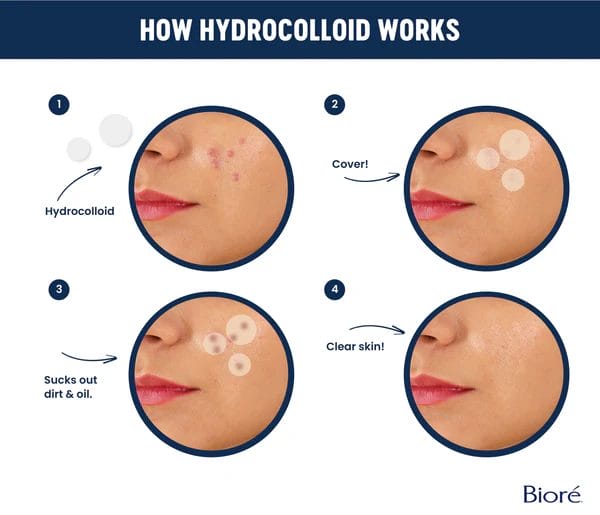 Hydrocolloid Patches Explained