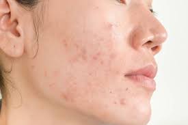 Hormonal Fluctuations and Acne