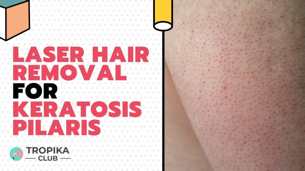 Laser Hair Removal for Keratosis Pilaris