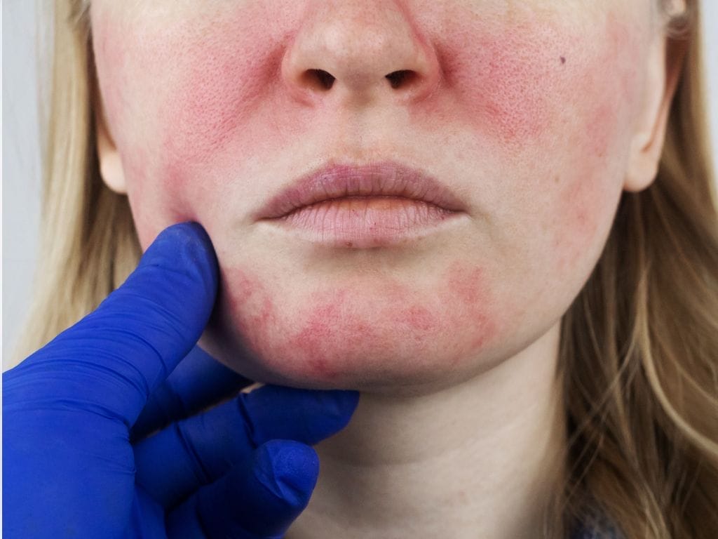 Blue Light: The Breakthrough Treatment for Rosacea