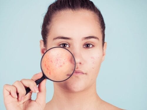 A Guide to Acne Scar Removal Options in Singapore