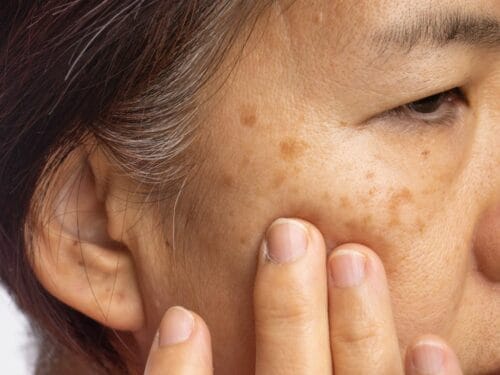 The Ultimate Guide to Pigmentation Removal Treatments in Singapore