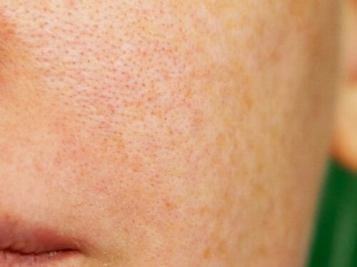 Understanding Pigmentation: Causes, Symptoms, and Treatments in Singapore